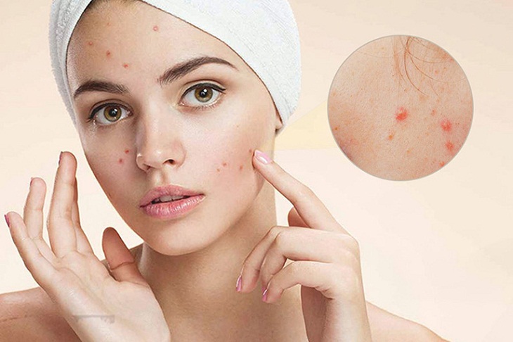 Vì sao cần chăm sóc da mặt bị mụn?